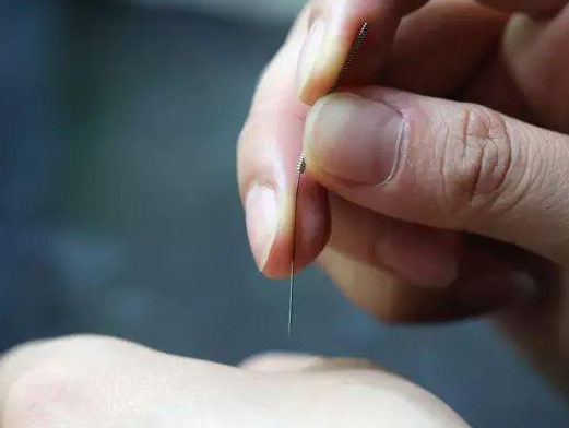 三棱針療法治療高燒嗎？